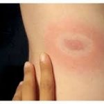 Прояви на шкірі та способи попередження кліщового бореліозу