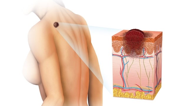 Новоутворення шкіри – чи завжди це рак шкіри?