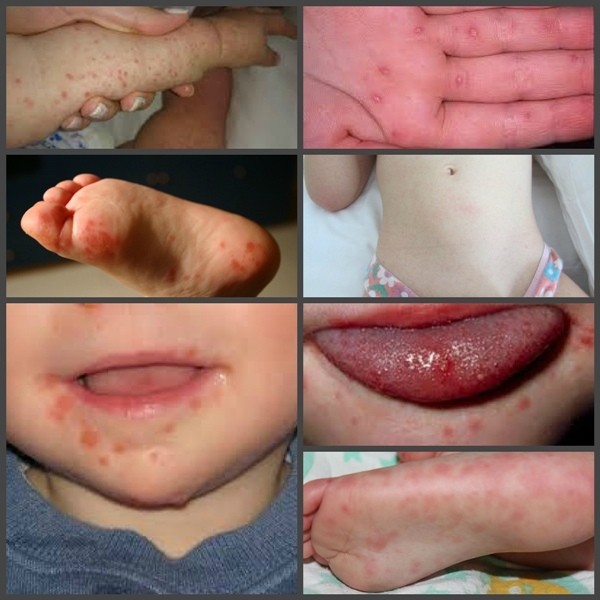 Віруси Коксакі або синдром «руки-ноги-рот»