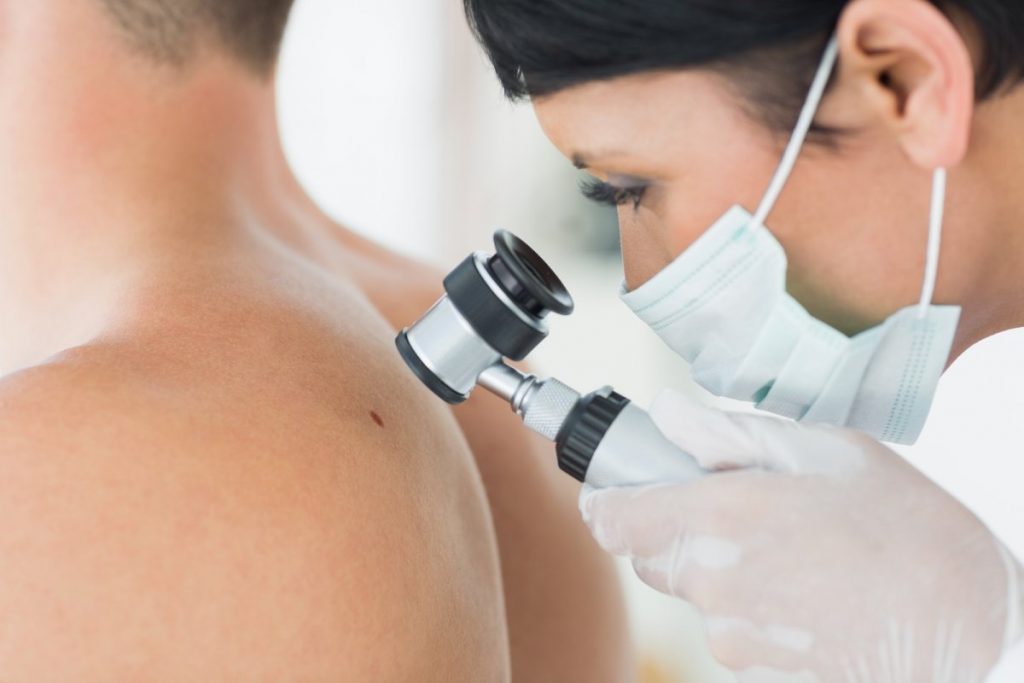 Меланома шкіри – одна із найнебезпечніших злоякісних пухлин