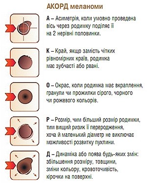 Злоякісна родимка: ознаки та визнання