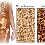 Що таке остеопороз?