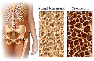 Що таке остеопороз?