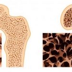 Як лікувати остеопороз суглобів і кісток у жінок в домашніх умовах