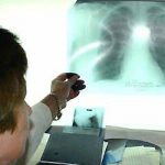 Хворі на заразні форми туберкульозу будуть примусово госпіталізовуватися за рішенням суду