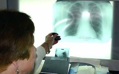 Хворі на заразні форми туберкульозу будуть примусово госпіталізовуватися за рішенням суду