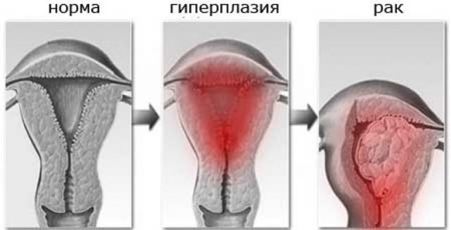 Як лікувати товстий ендометрій?