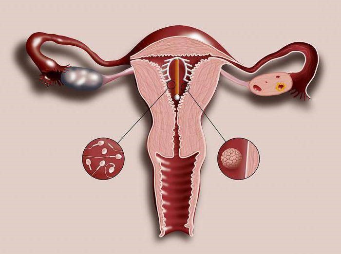 Внутрішньоматкові методи контрацепції: всі «за» і «проти»