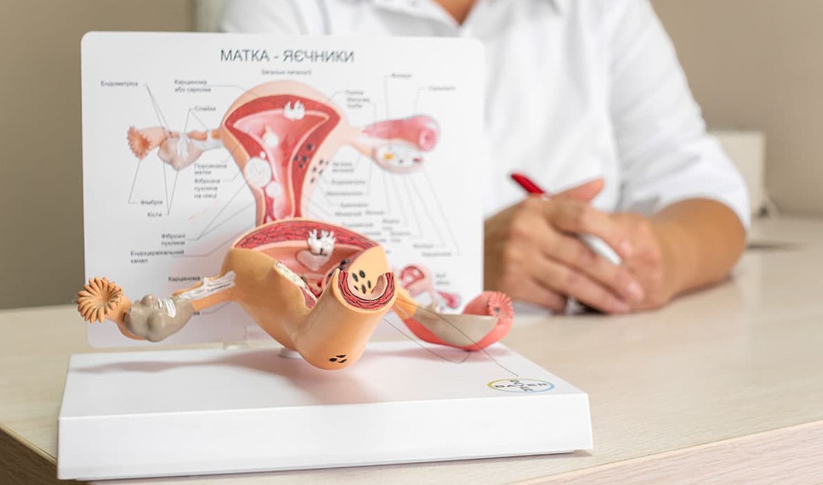 Цервікальна інтраепітеліальна неоплазія: передраковий стан, який можна виявити й вилікувати. Чому профілактика раку шийки матки — ключовий напрям у боротьбі з онкопатологією